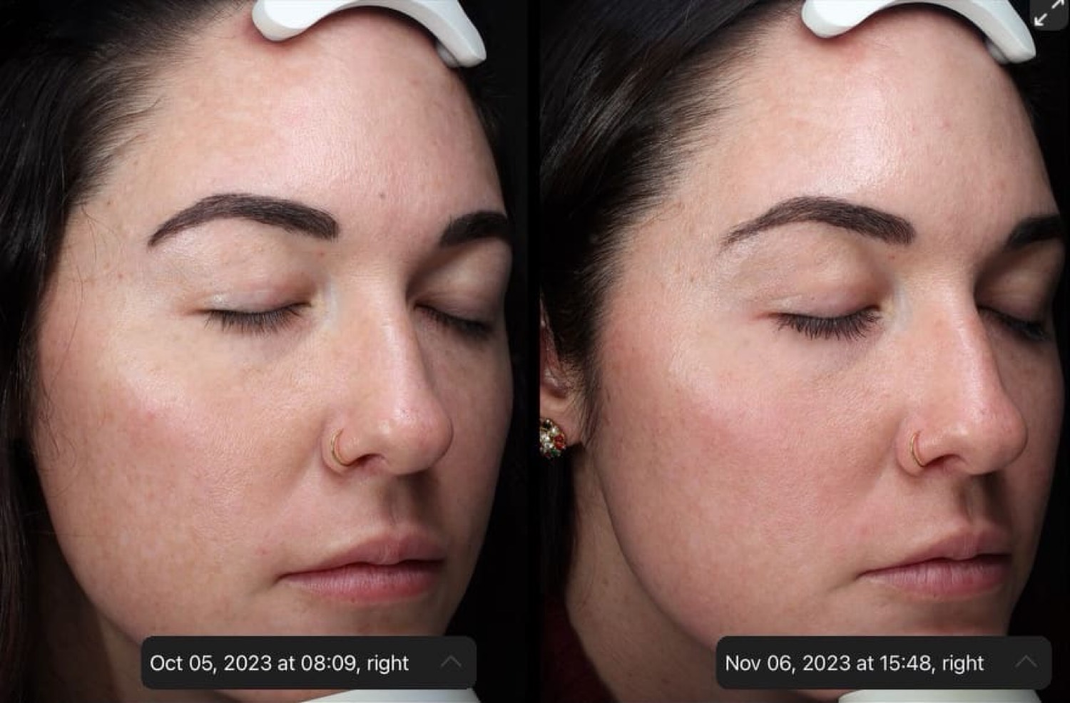 Before and After EvePro Glow Session